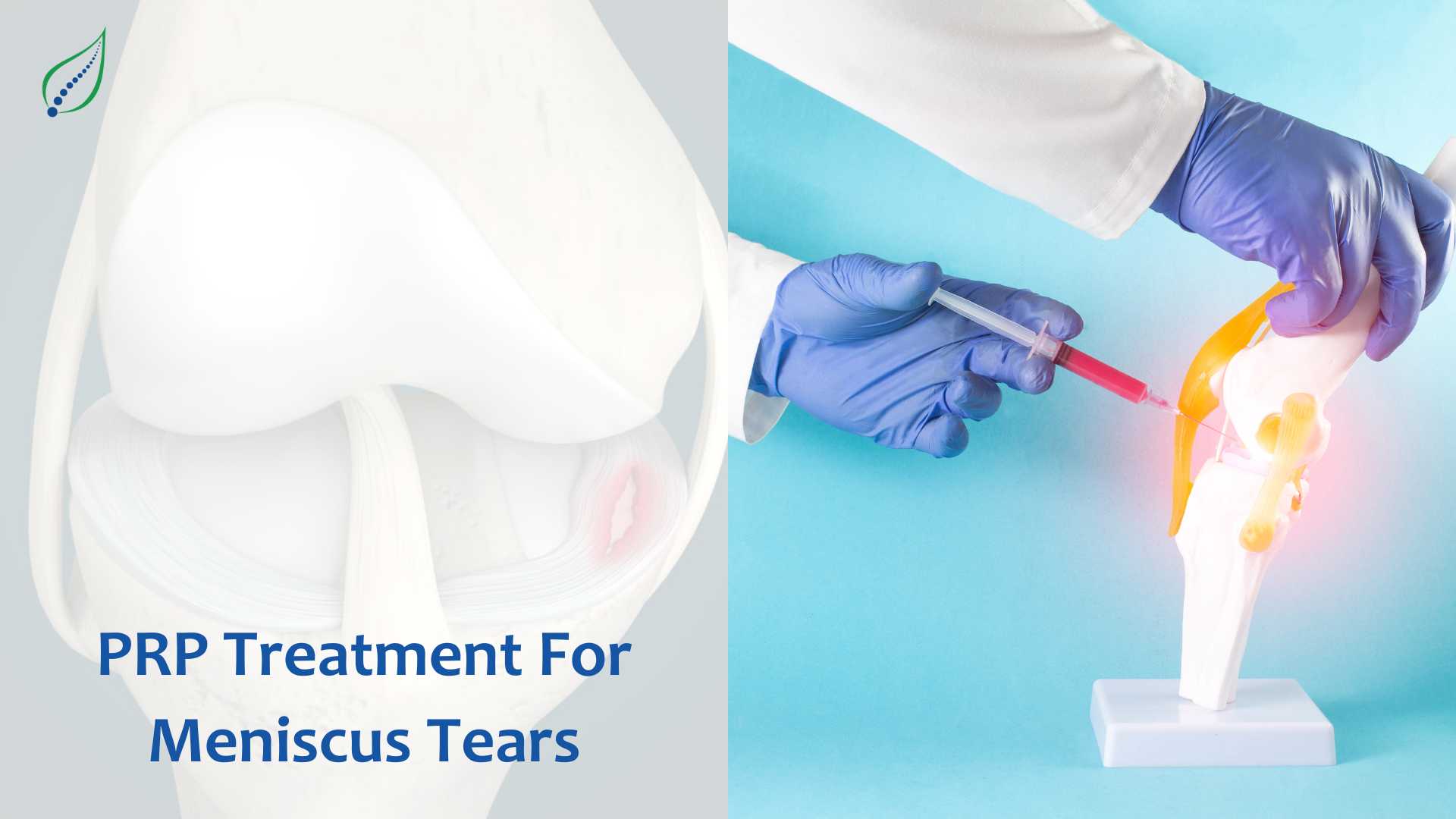 PRP Treatment For Meniscus Tears